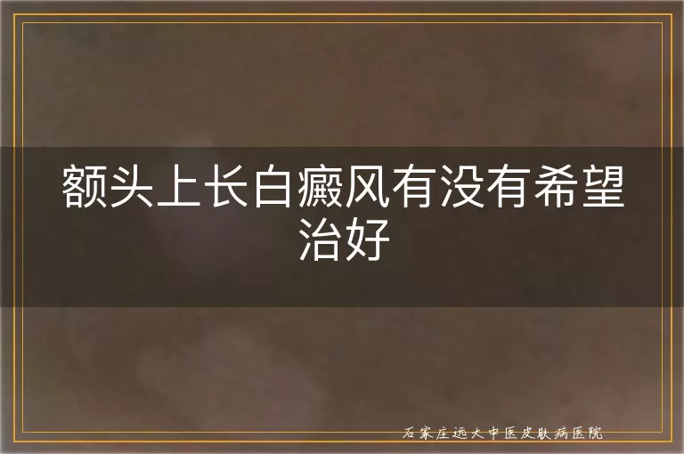 额头上长白癜风有没有希望治好