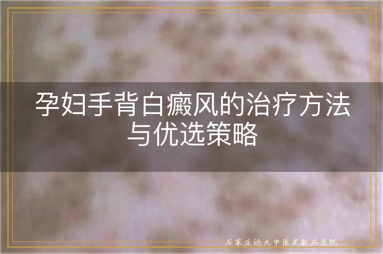 孕妇手背白癜风的治疗方法与优选策略