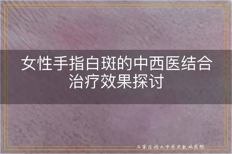 女性手指白斑的中西医结合治疗效果探讨