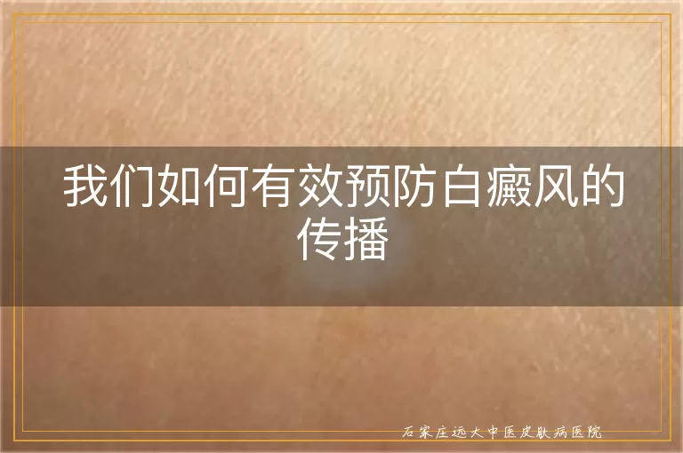 我们如何有效预防白癜风的传播