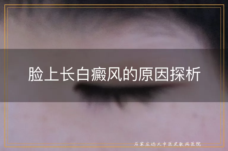 脸上长白癜风的原因探析