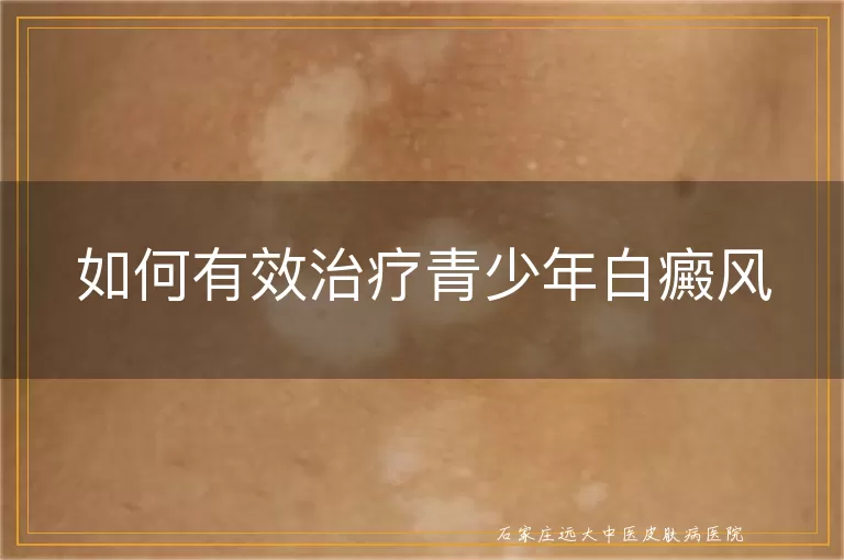 如何有效治疗青少年白癜风