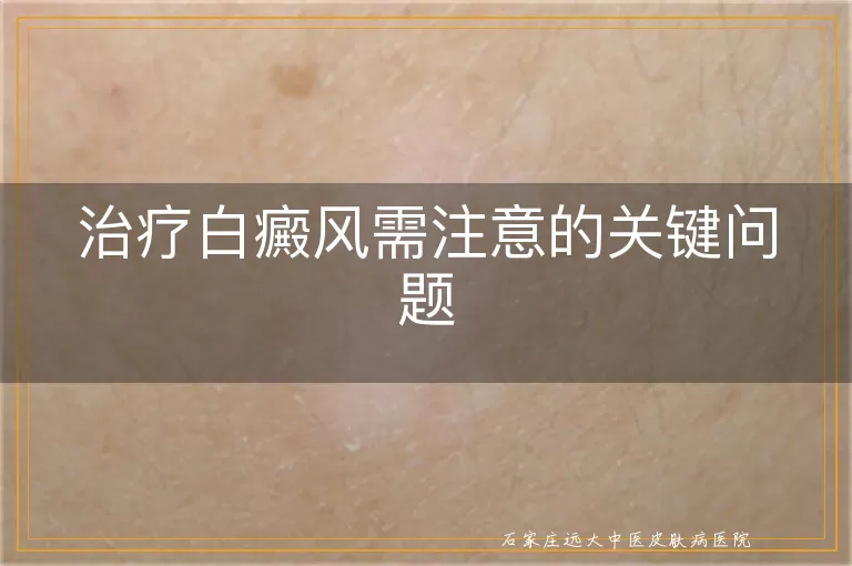 治疗白癜风需注意的关键问题