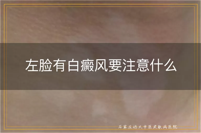 左脸有白癜风要注意什么
