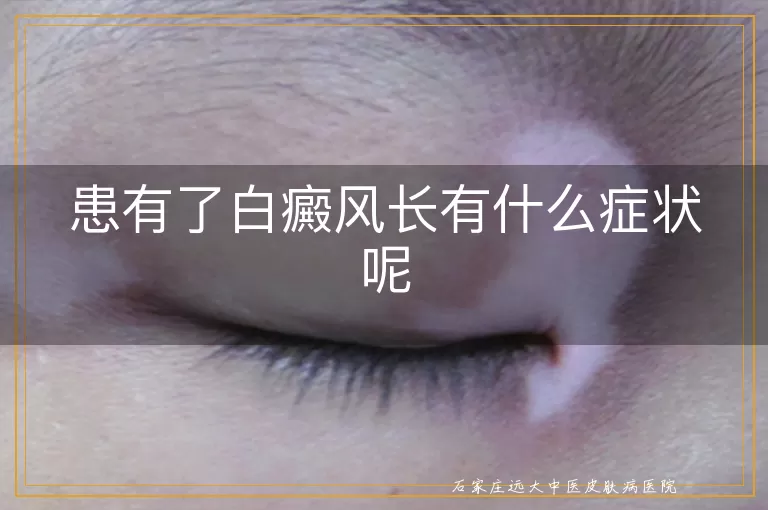 患有了白癜风长有什么症状呢