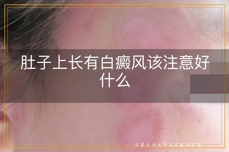 肚子上长有白癜风该注意好什么
