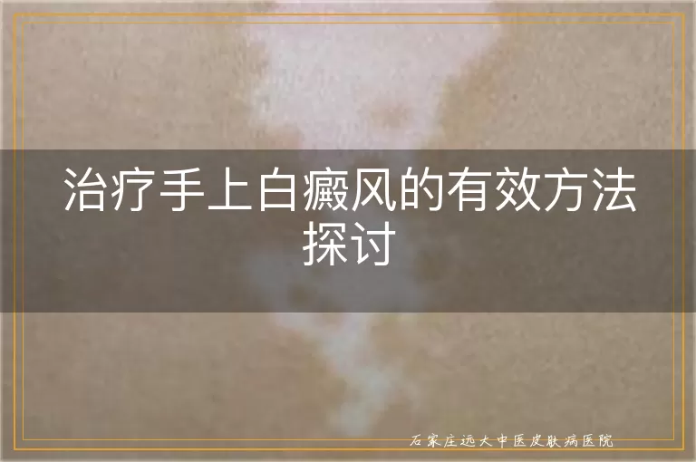 治疗手上白癜风的有效方法探讨