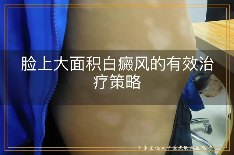 脸上大面积白癜风的有效治疗策略