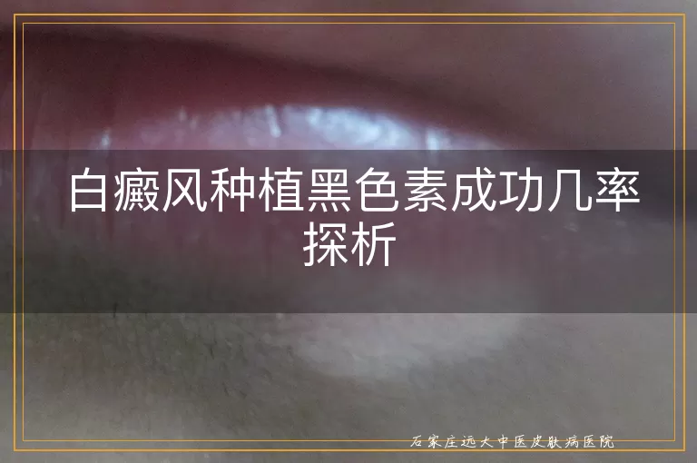 白癜风种植黑色素成功几率探析