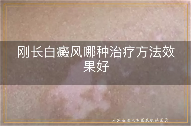 刚长白癜风哪种治疗方法效果好