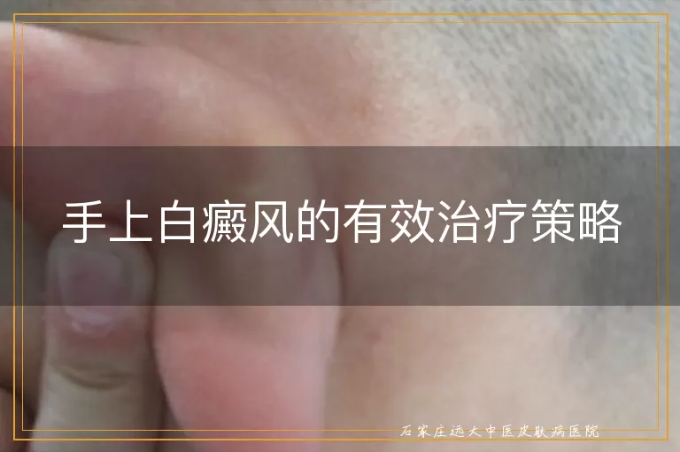 手上白癜风的有效治疗策略