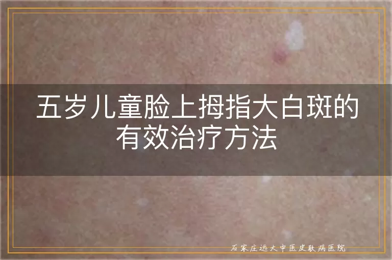 五岁儿童脸上拇指大白斑的有效治疗方法