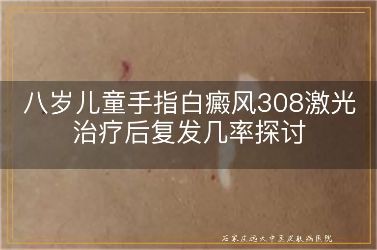 八岁儿童手指白癜风308激光治疗后复发几率探讨