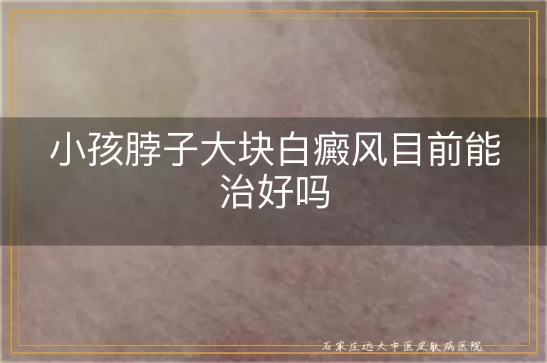 小孩脖子大块白癜风目前能治好吗