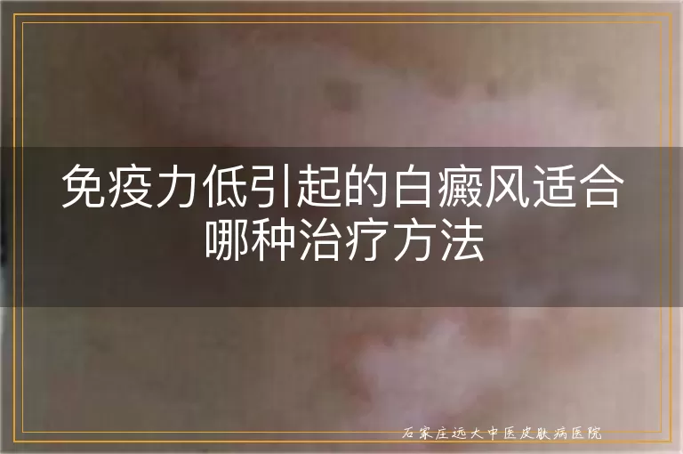 免疫力低引起的白癜风适合哪种治疗方法