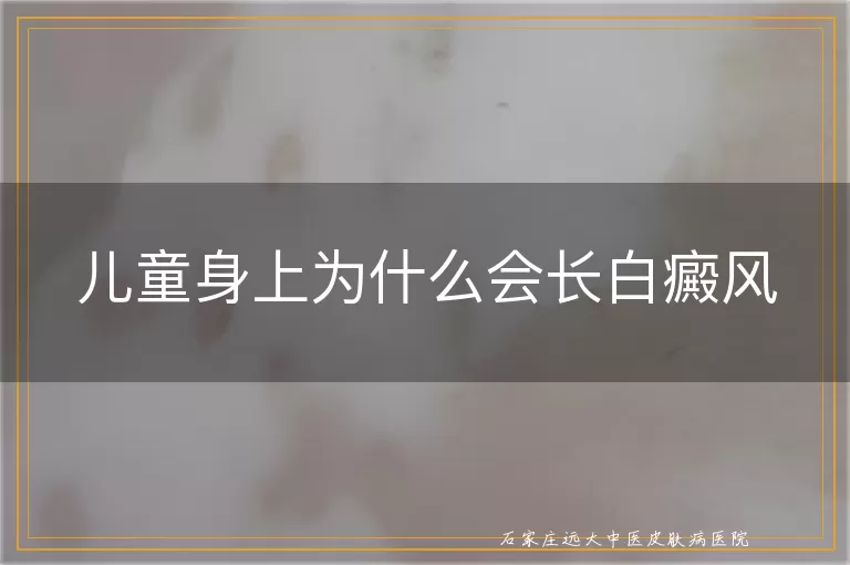 儿童身上为什么会长白癜风