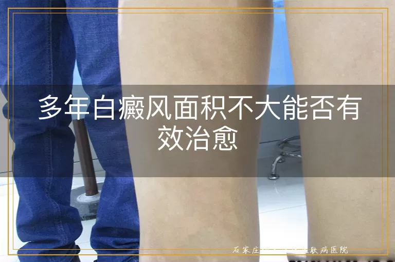 多年白癜风面积不大能否有效治愈