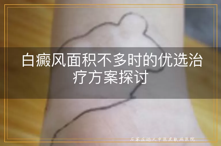 白癜风面积不多时的优选治疗方案探讨