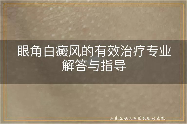 眼角白癜风的有效治疗专业解答与指导