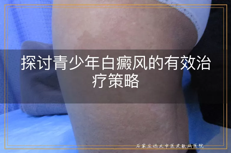 探讨青少年白癜风的有效治疗策略