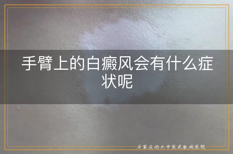 手臂上的白癜风会有什么症状呢