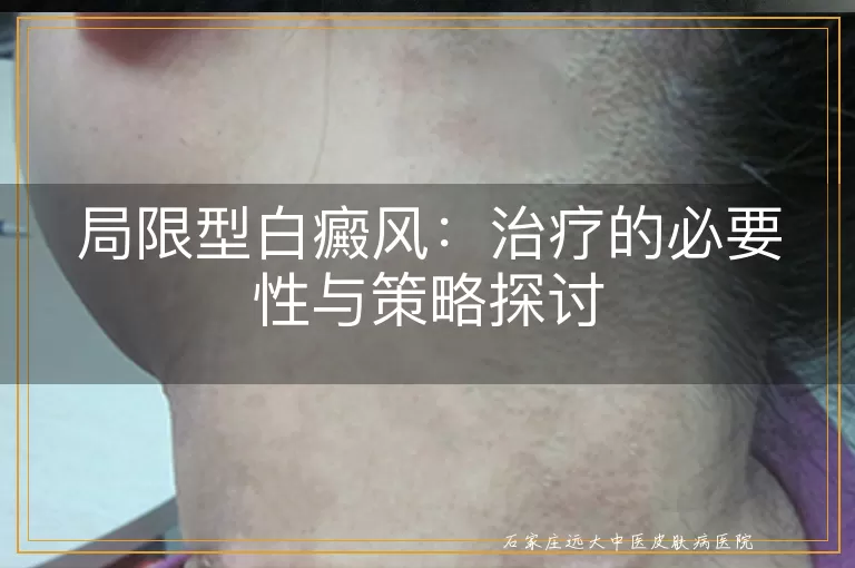 局限型白癜风：治疗的必要性与策略探讨