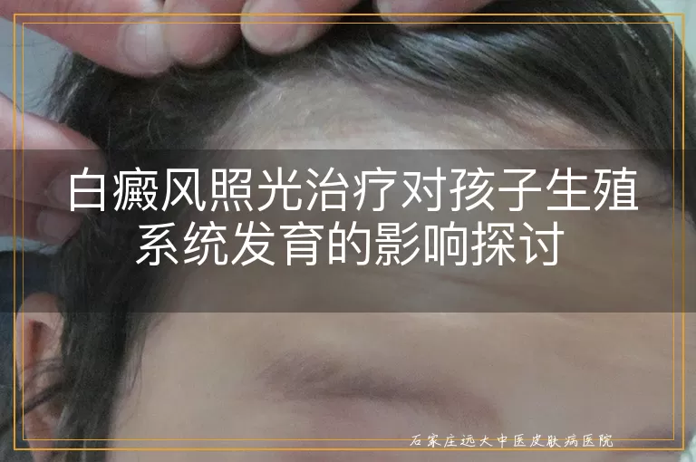 白癜风照光治疗对孩子生殖系统发育的影响探讨