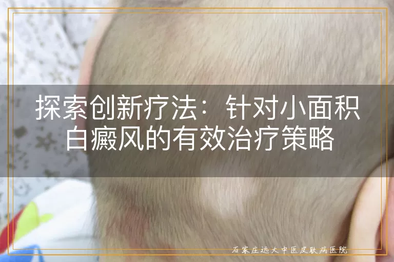 探索创新疗法：针对小面积白癜风的有效治疗策略
