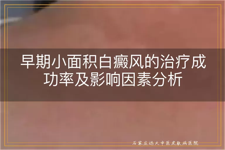 早期小面积白癜风的治疗成功率及影响因素分析