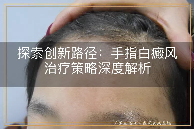 探索创新路径：手指白癜风治疗策略深度解析