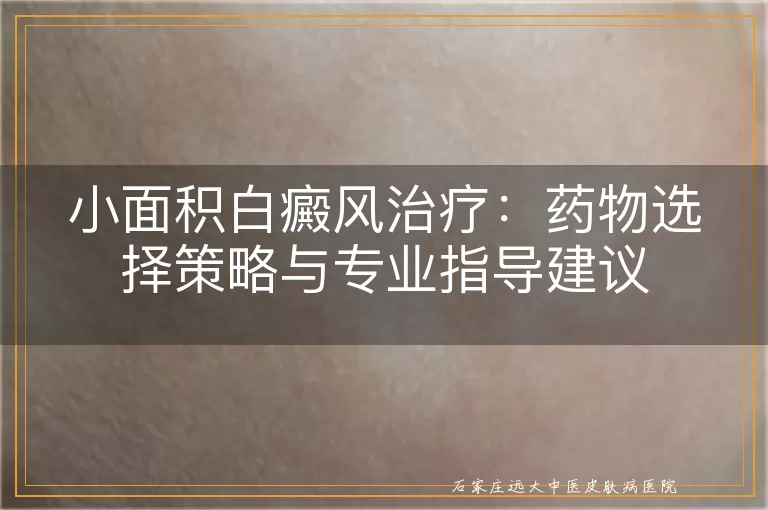 小面积白癜风治疗：药物选择策略与专业指导建议