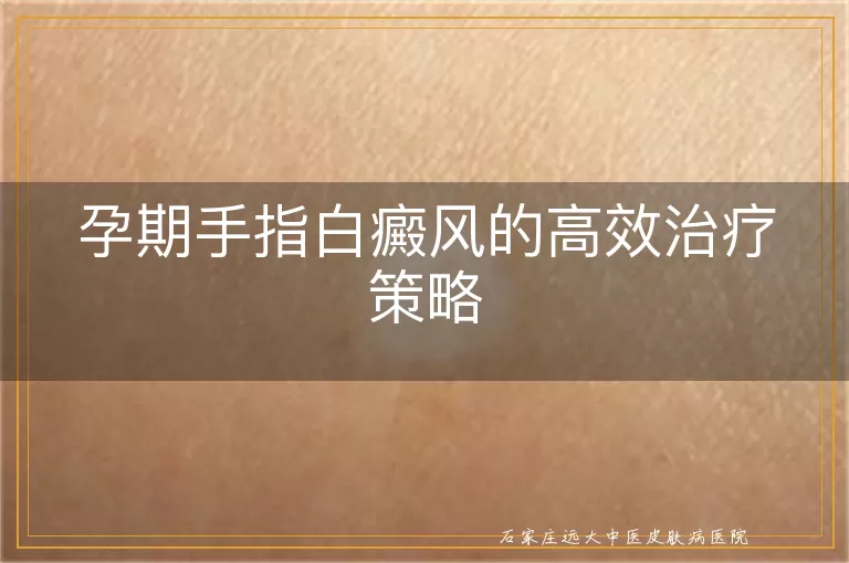 孕期手指白癜风的高效治疗策略