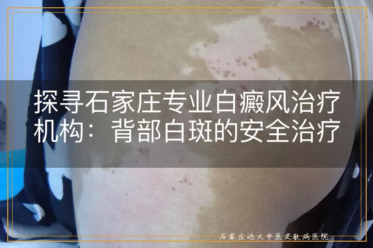 探寻石家庄专业白癜风治疗机构：背部白斑的安全治疗之道