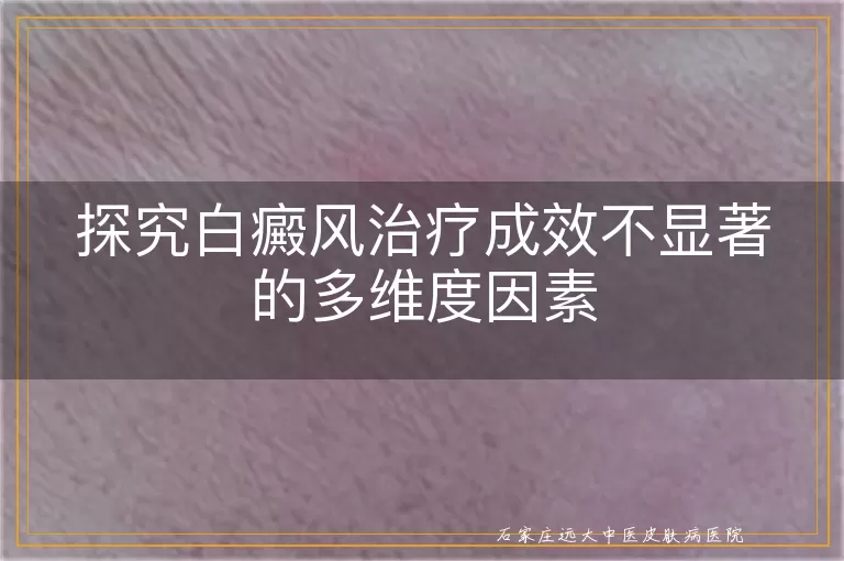 探究白癜风治疗成效不显著的多维度因素