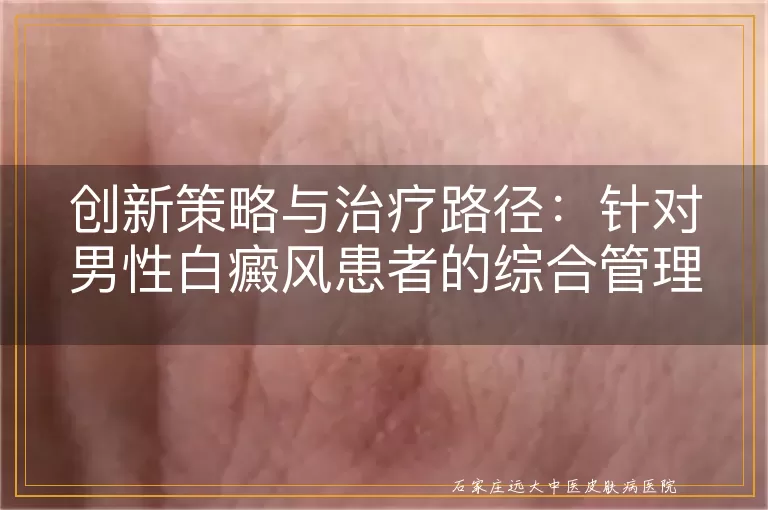 创新策略与治疗路径：针对男性白癜风患者的综合管理方案