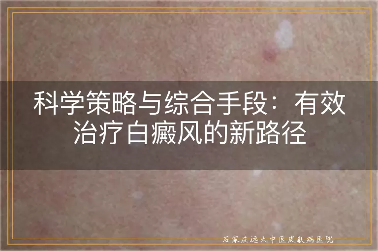科学策略与综合手段：有效治疗白癜风的新路径