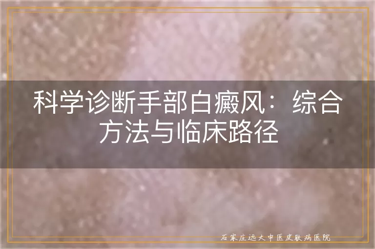 科学诊断手部白癜风：综合方法与临床路径
