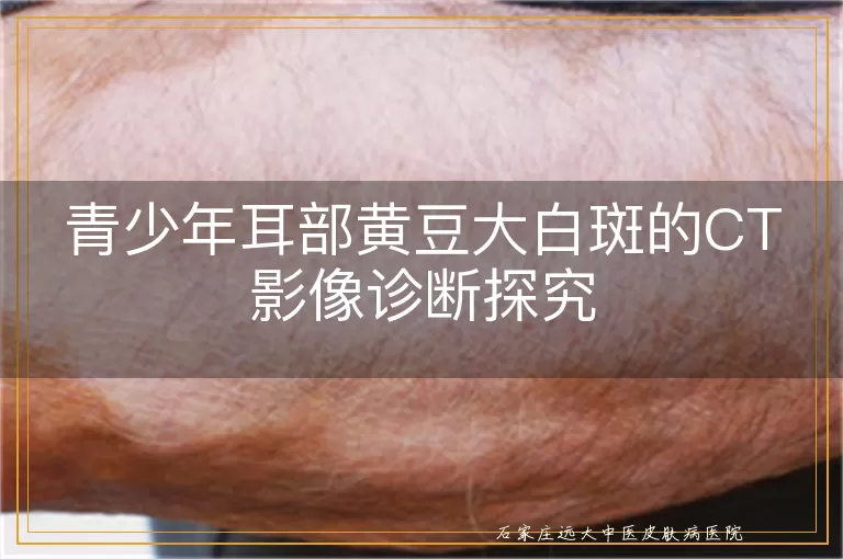 青少年耳部黄豆大白斑的CT影像诊断探究