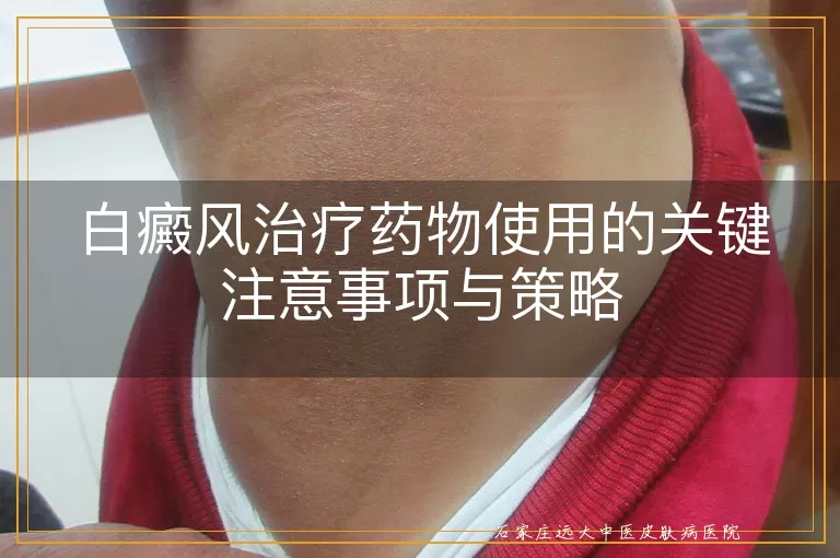 白癜风治疗药物使用的关键注意事项与策略