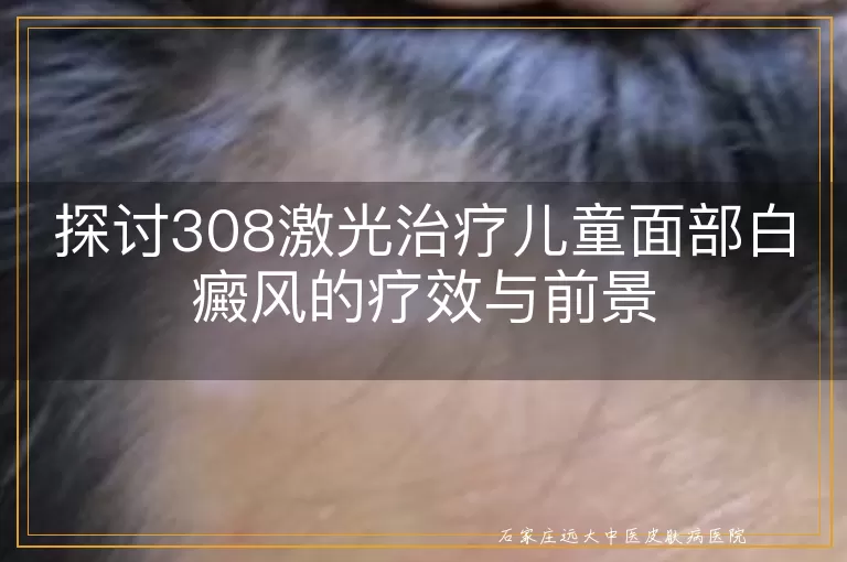 探讨308激光治疗儿童面部白癜风的疗效与前景