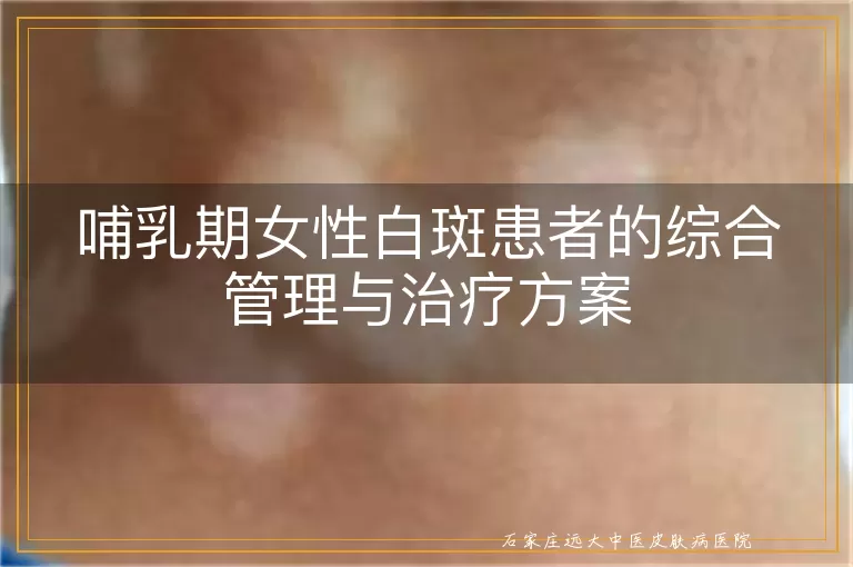 哺乳期女性白斑患者的综合管理与治疗方案