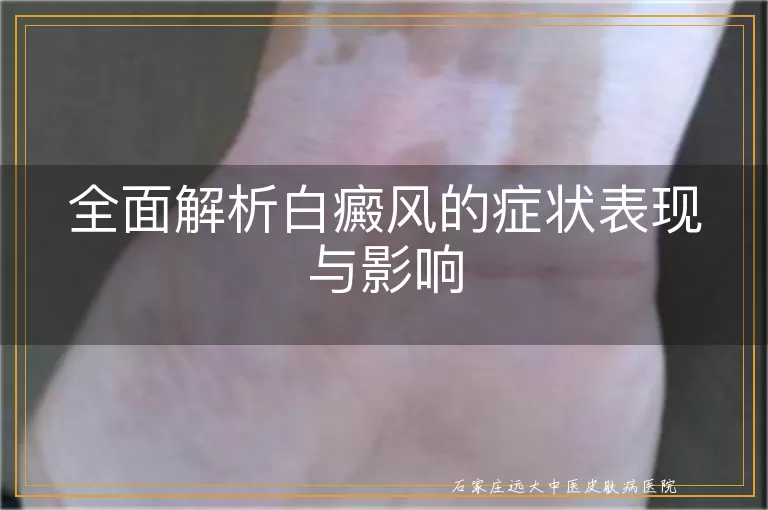 全面解析白癜风的症状表现与影响