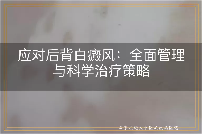 应对后背白癜风：全面管理与科学治疗策略