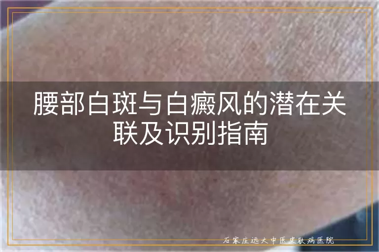 腰部白斑与白癜风的潜在关联及识别指南
