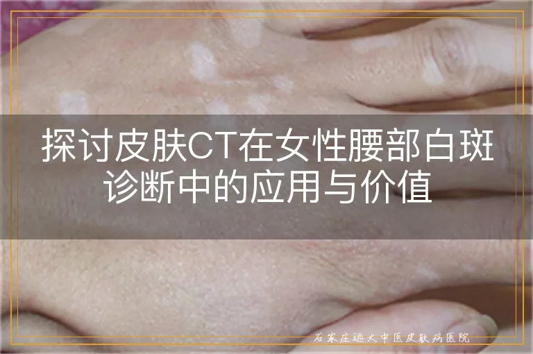 探讨皮肤CT在女性腰部白斑诊断中的应用与价值