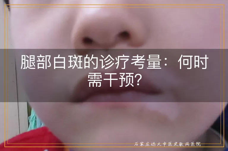 腿部白斑的诊疗考量：何时需干预？