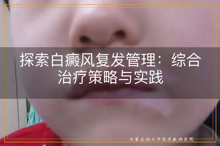 探索白癜风复发管理：综合治疗策略与实践