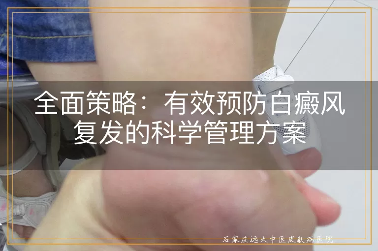 全面策略：有效预防白癜风复发的科学管理方案
