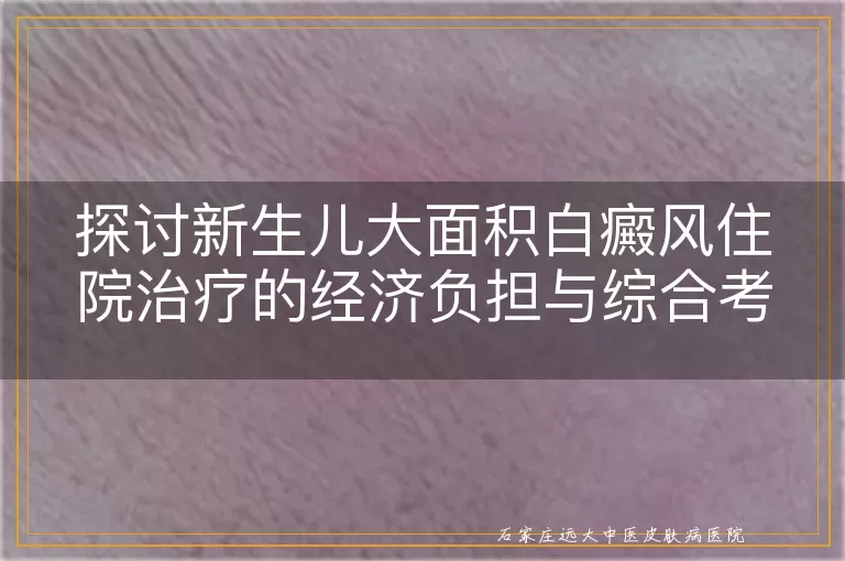 探讨新生儿大面积白癜风住院治疗的经济负担与综合考量