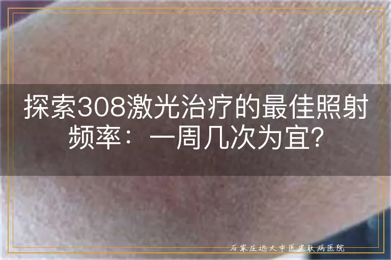 探索308激光治疗的最佳照射频率：一周几次为宜？